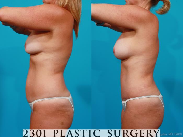 Before & After Silicone Implants Case 195 View #4 View in Fort Worth, Plano, & Frisco, Texas
