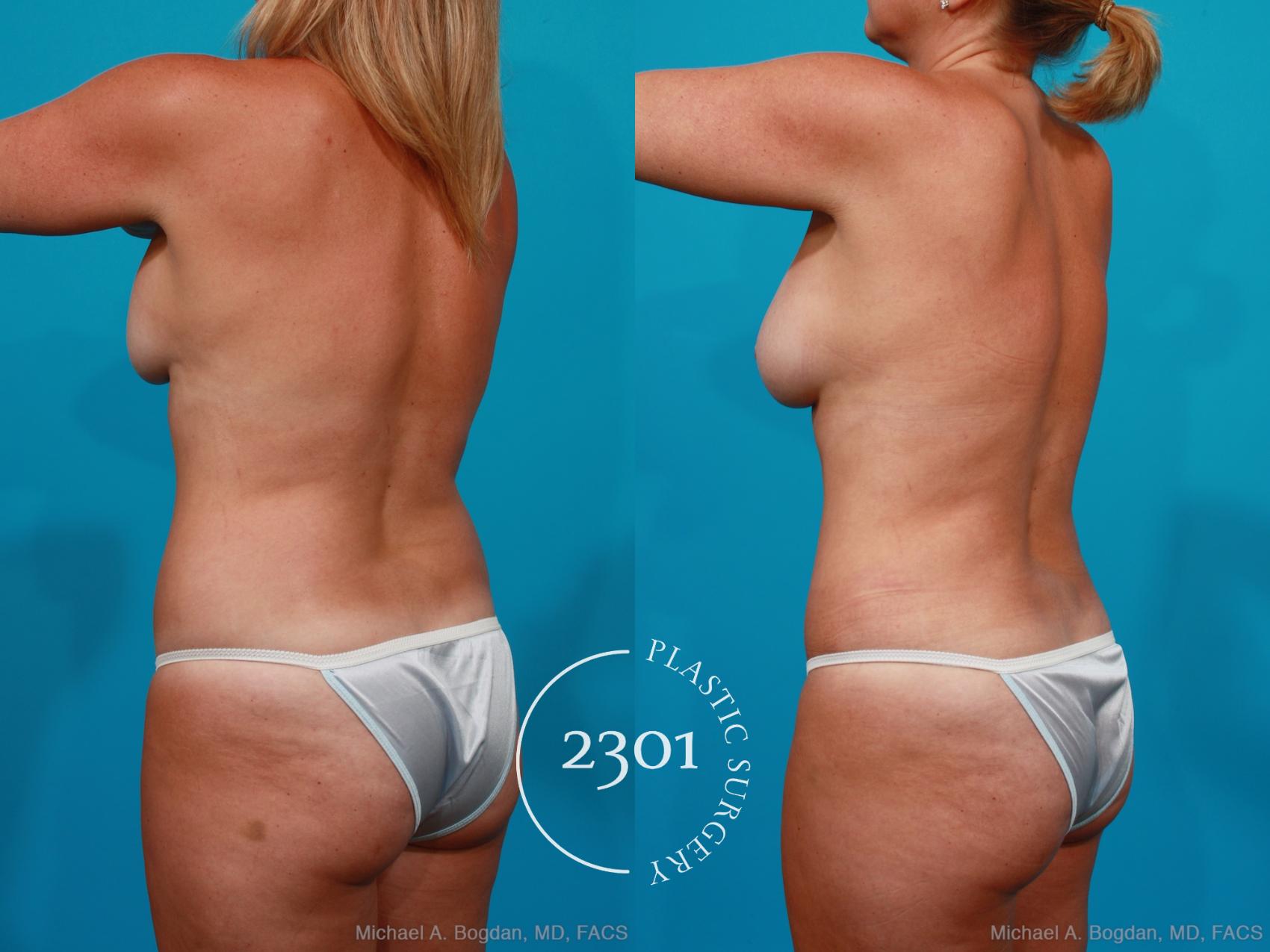 Before & After Silicone Implants Case 195 View #5 View in Fort Worth, Plano, & Frisco, Texas