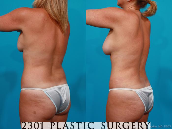 Before & After Silicone Implants Case 195 View #5 View in Fort Worth, Plano, & Frisco, Texas