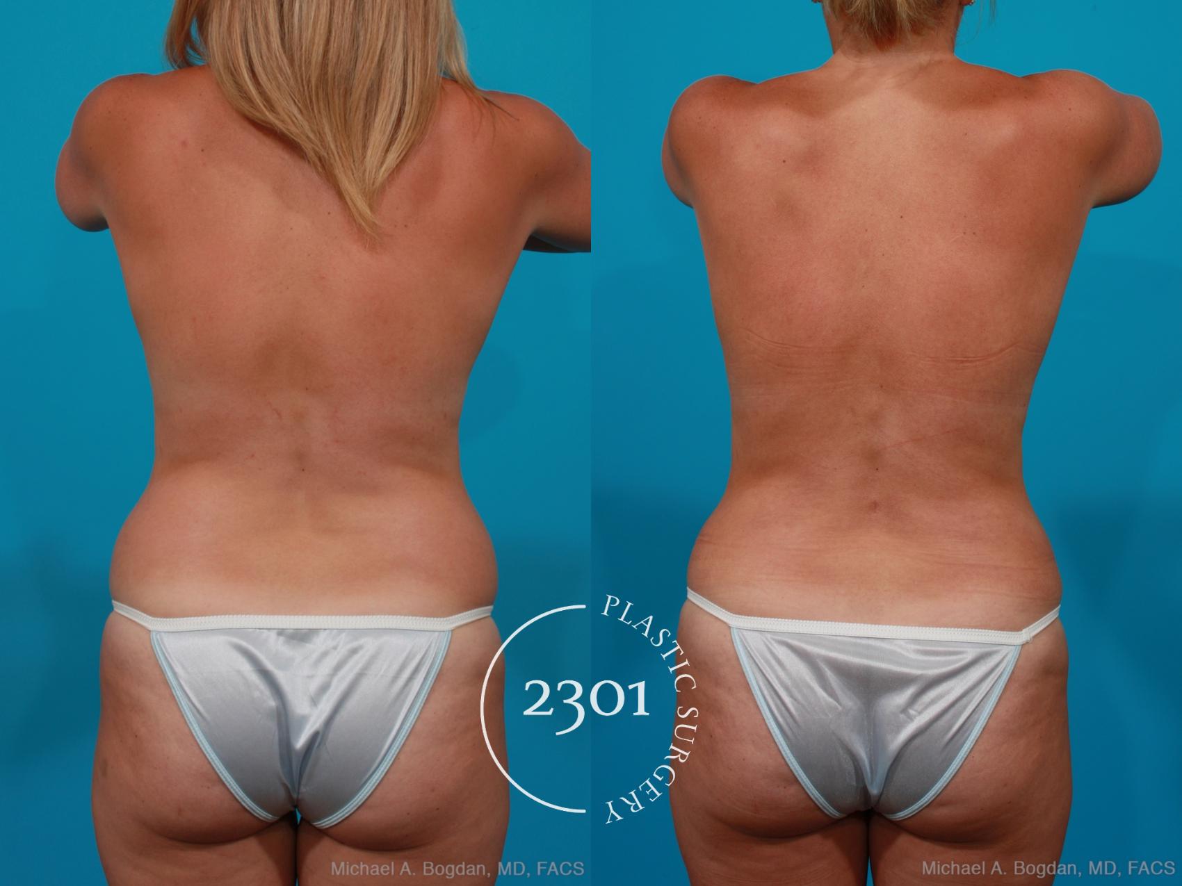 Before & After Silicone Implants Case 195 View #6 View in Fort Worth, Plano, & Frisco, Texas