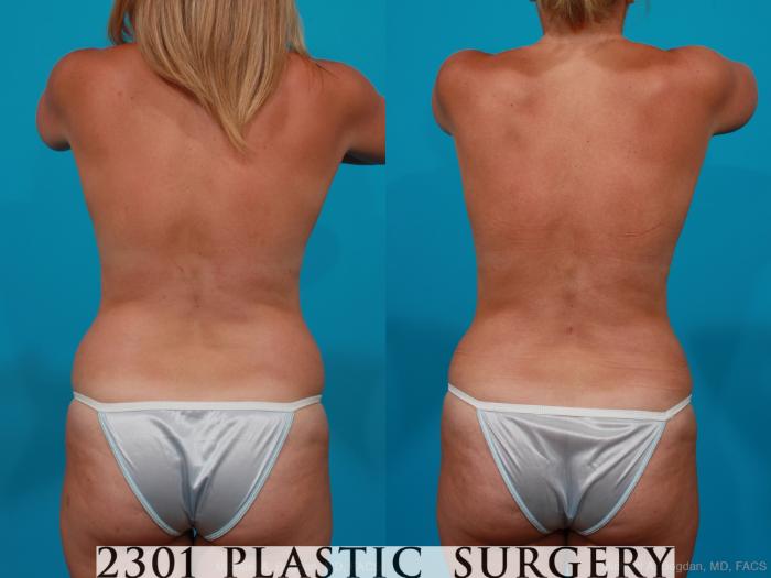 Before & After Silicone Implants Case 195 View #6 View in Fort Worth, Plano, & Frisco, Texas