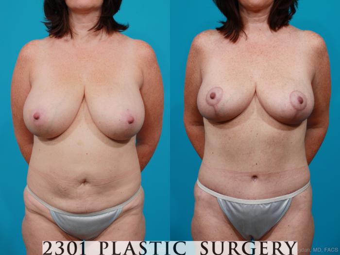 Before & After Breast Reduction Case 200 View #1 View in Fort Worth & Frisco, Texas