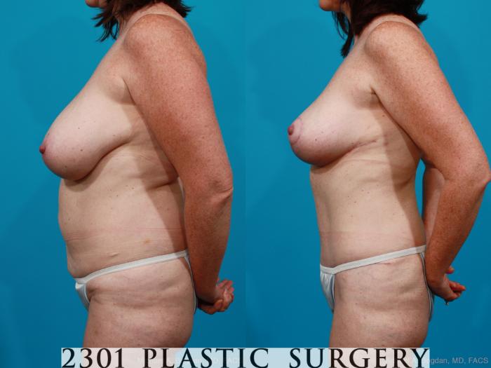 Before & After Breast Reduction Case 200 View #2 View in Fort Worth, Plano, & Frisco, Texas