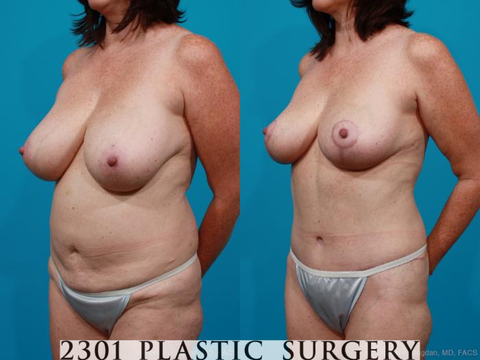 Before & After Breast Reduction Case 200 View #3 View in Fort Worth, Plano, & Frisco, Texas