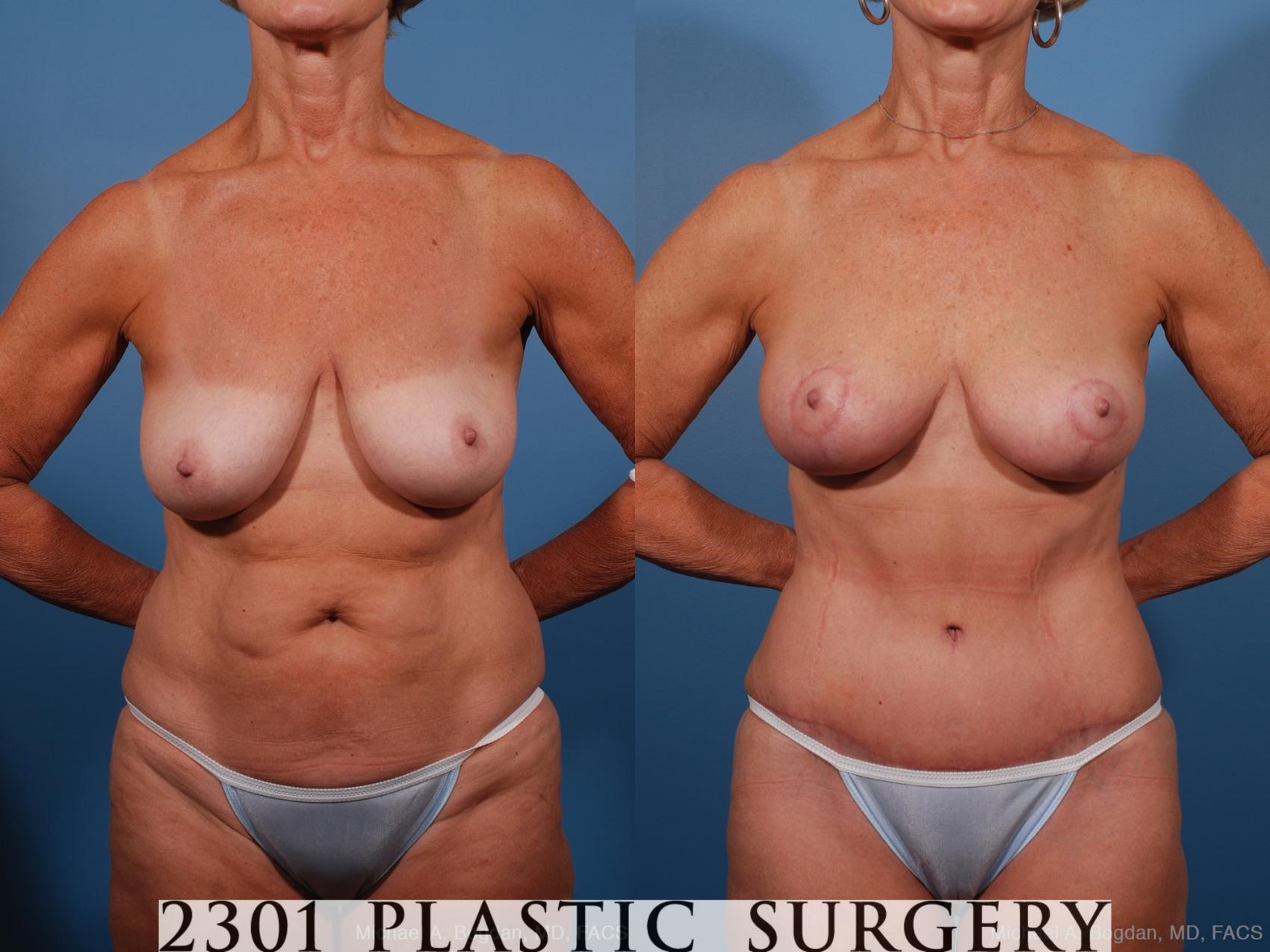 Before & After Liposuction Case 201 View #1 View in Fort Worth, Plano, & Frisco, Texas