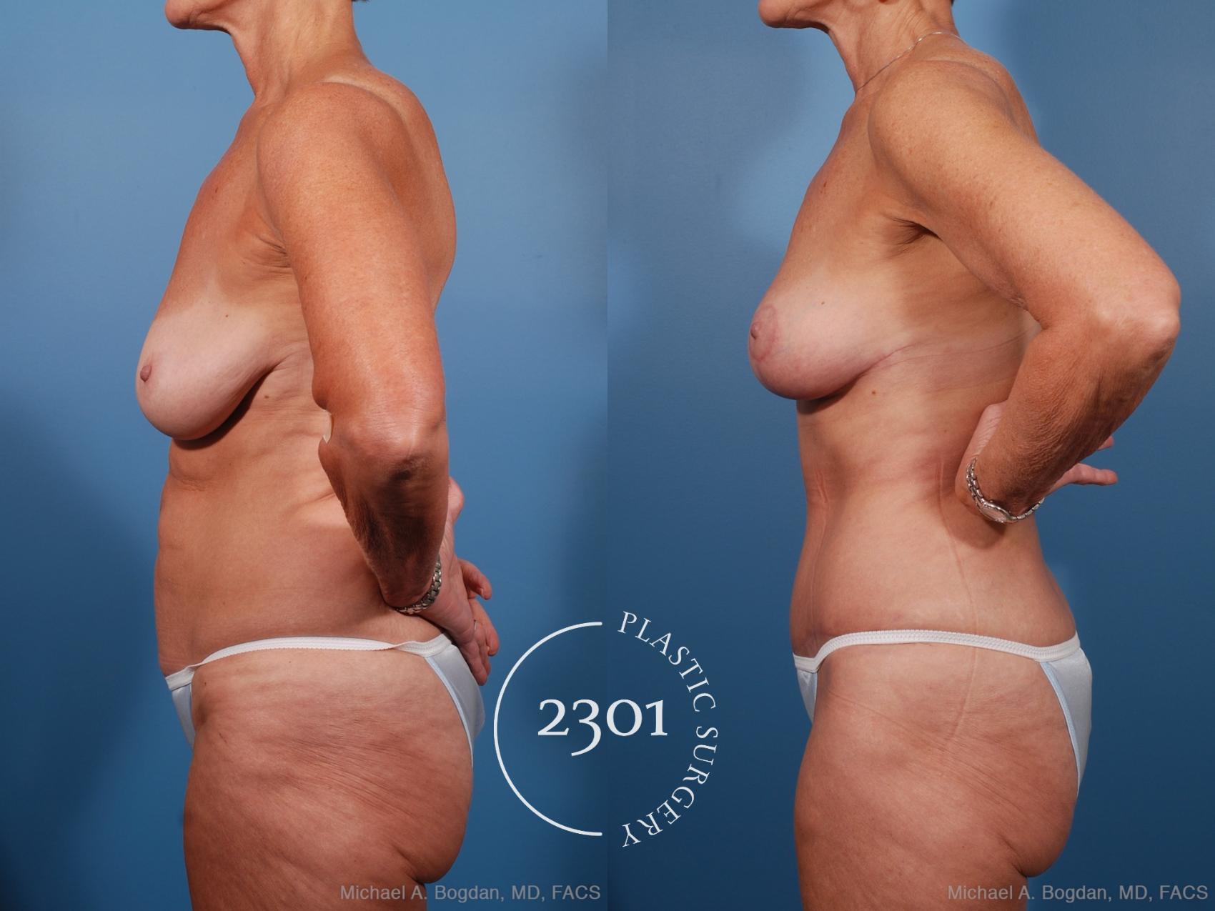 Before & After Mommy Makeover Case 201 View #2 View in Fort Worth, Plano, & Frisco, Texas