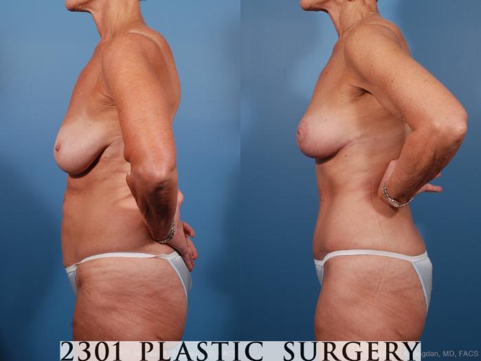 Before & After Liposuction Case 201 View #2 View in Fort Worth, Plano, & Frisco, Texas