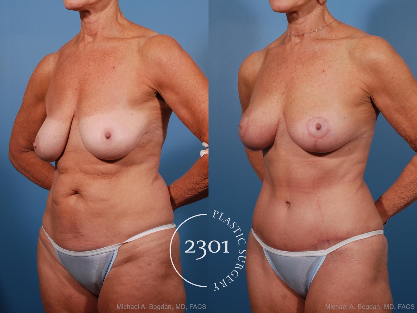Before & After Mommy Makeover Case 201 View #3 View in Fort Worth, Plano, & Frisco, Texas