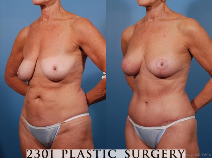 Before & After Liposuction Case 201 View #3 View in Fort Worth, Plano, & Frisco, Texas