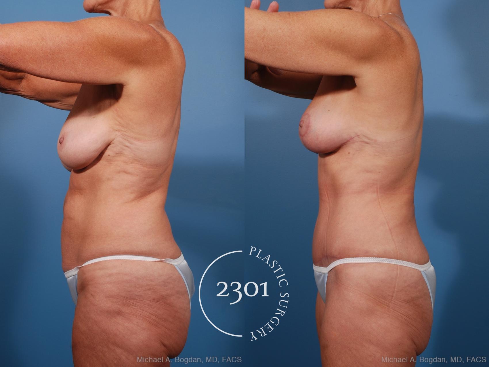 Before & After Mommy Makeover Case 201 View #4 View in Fort Worth, Plano, & Frisco, Texas