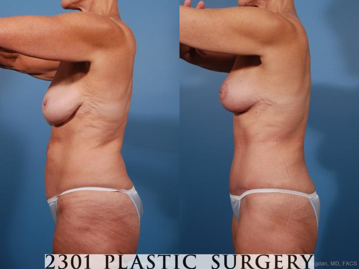 Before & After Liposuction Case 201 View #4 View in Fort Worth, Plano, & Frisco, Texas