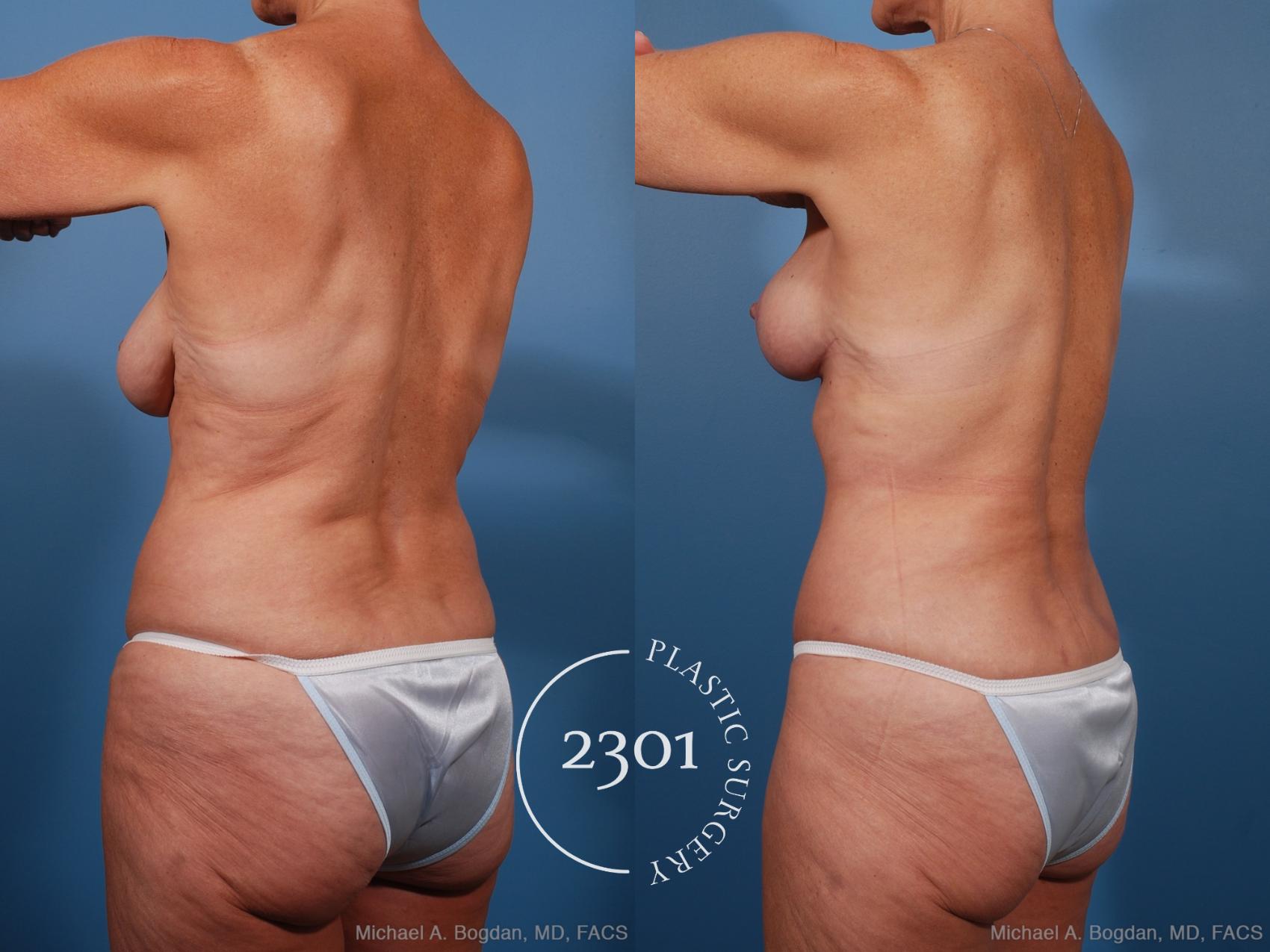 Before & After Mommy Makeover Case 201 View #5 View in Fort Worth, Plano, & Frisco, Texas