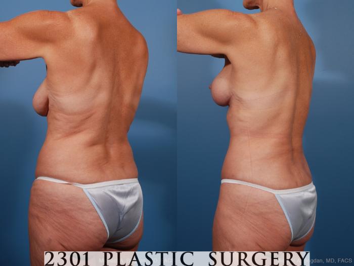 Before & After Liposuction Case 201 View #5 View in Fort Worth, Plano, & Frisco, Texas