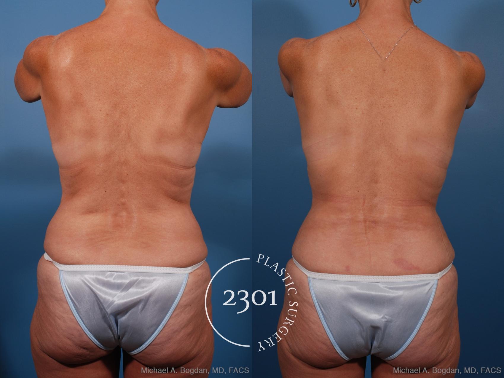 Before & After Mommy Makeover Case 201 View #6 View in Fort Worth, Plano, & Frisco, Texas