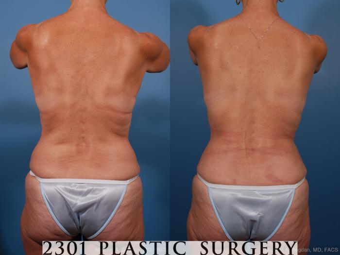 Before & After Tummy Tuck Case 201 View #6 View in Fort Worth, Plano, & Frisco, Texas