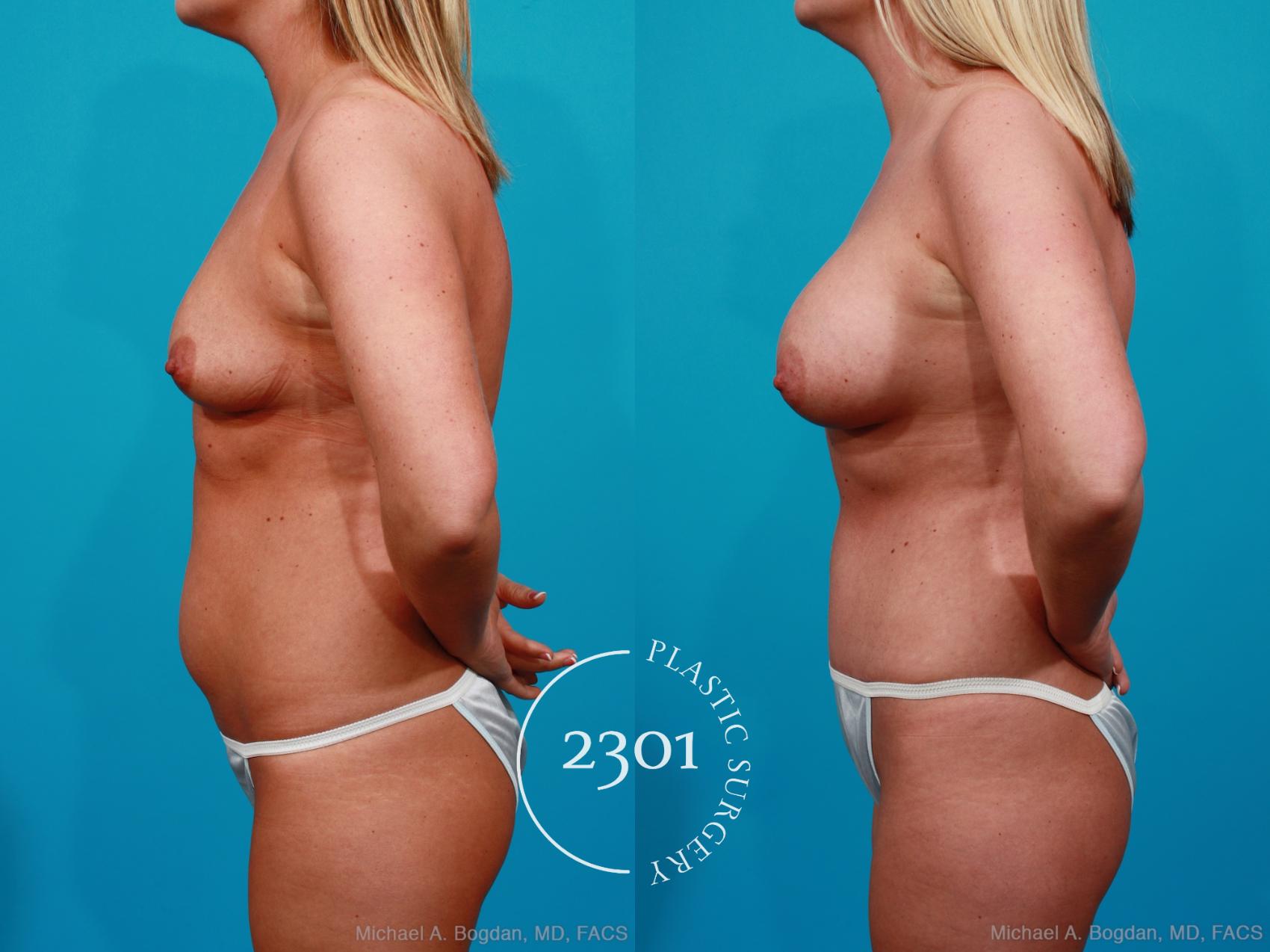 Before & After Silicone Implants Case 222 View #2 View in Fort Worth, Plano, & Frisco, Texas
