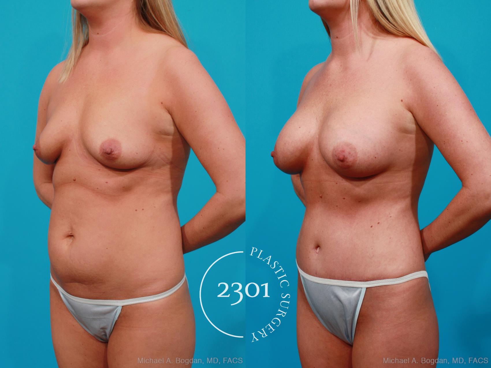 Before & After Silicone Implants Case 222 View #3 View in Fort Worth, Plano, & Frisco, Texas