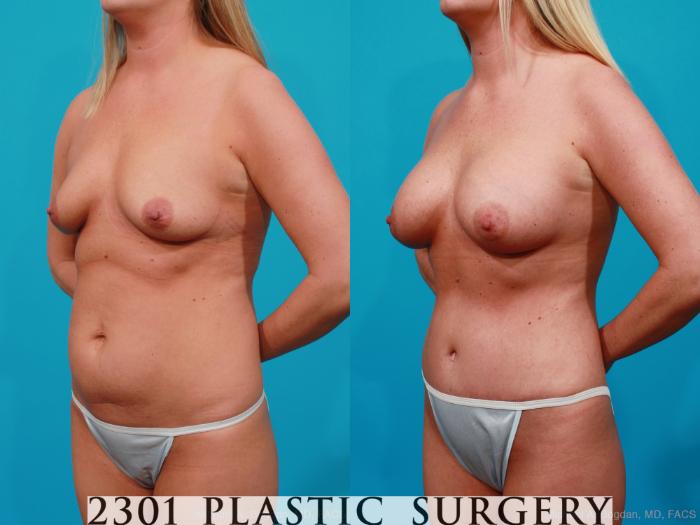 Before & After Mommy Makeover Case 222 View #3 View in Fort Worth, Plano, & Frisco, Texas