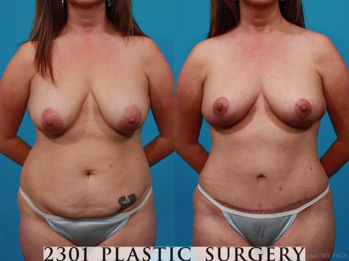 Before & After Liposuction Case 228 View #1 View in Fort Worth & Frisco, Texas