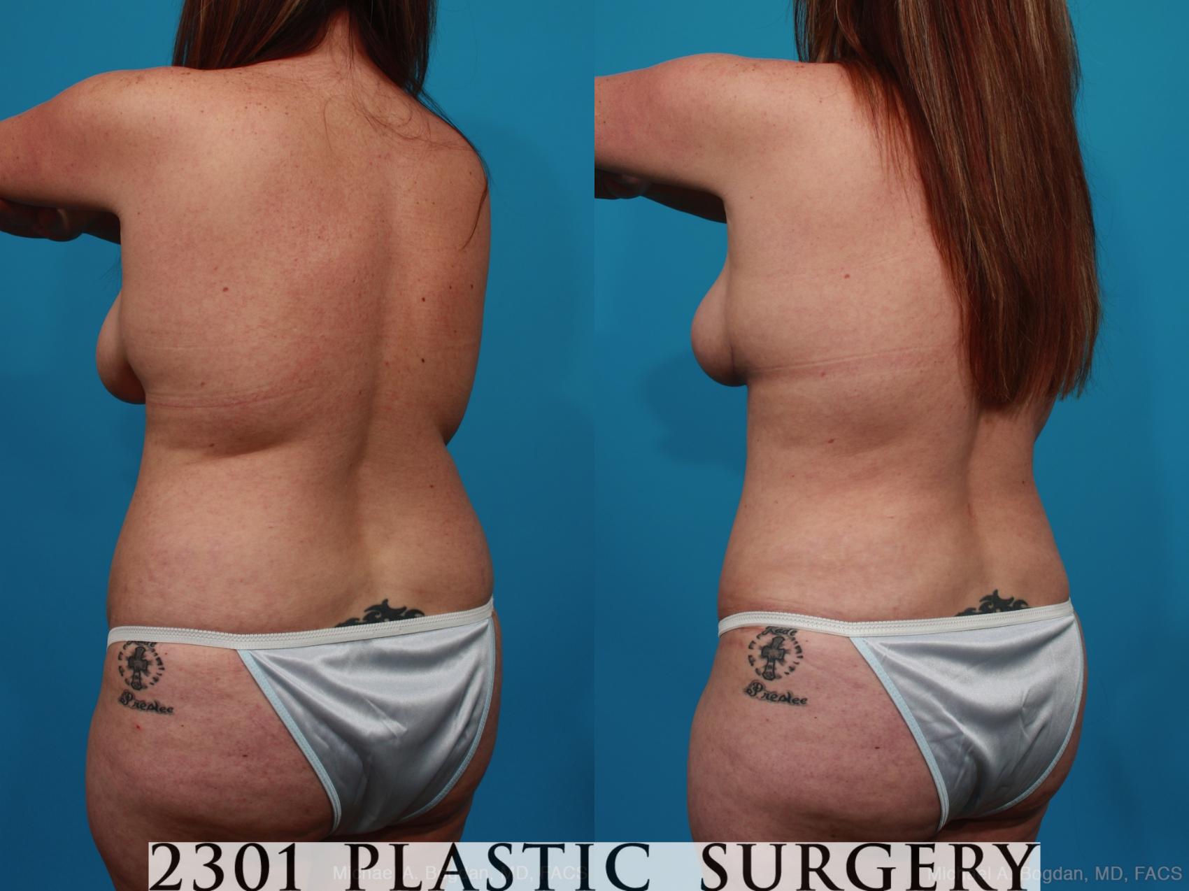 Before & After Mommy Makeover Case 228 View #4 View in Fort Worth & Frisco, Texas
