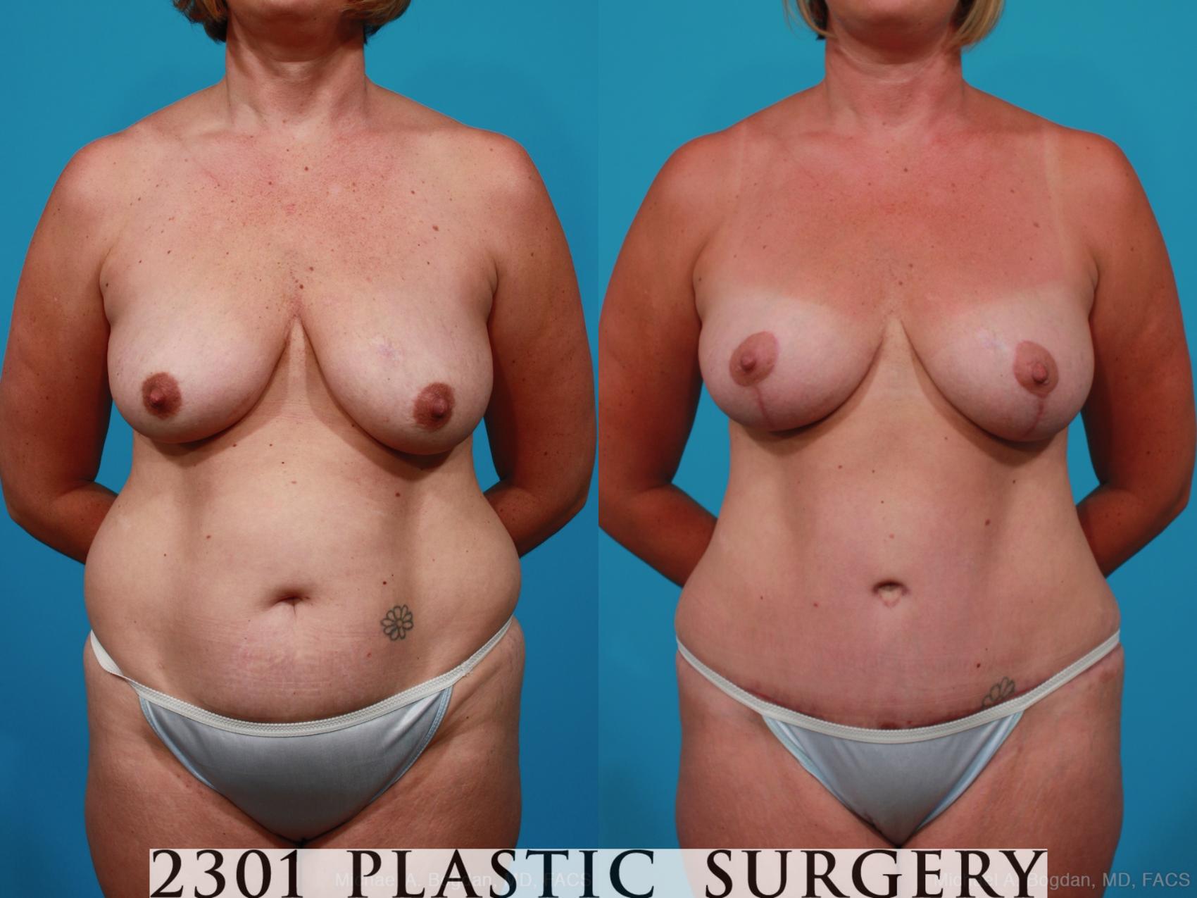Before & After Liposuction Case 231 View #1 View in Fort Worth, Plano, & Frisco, Texas