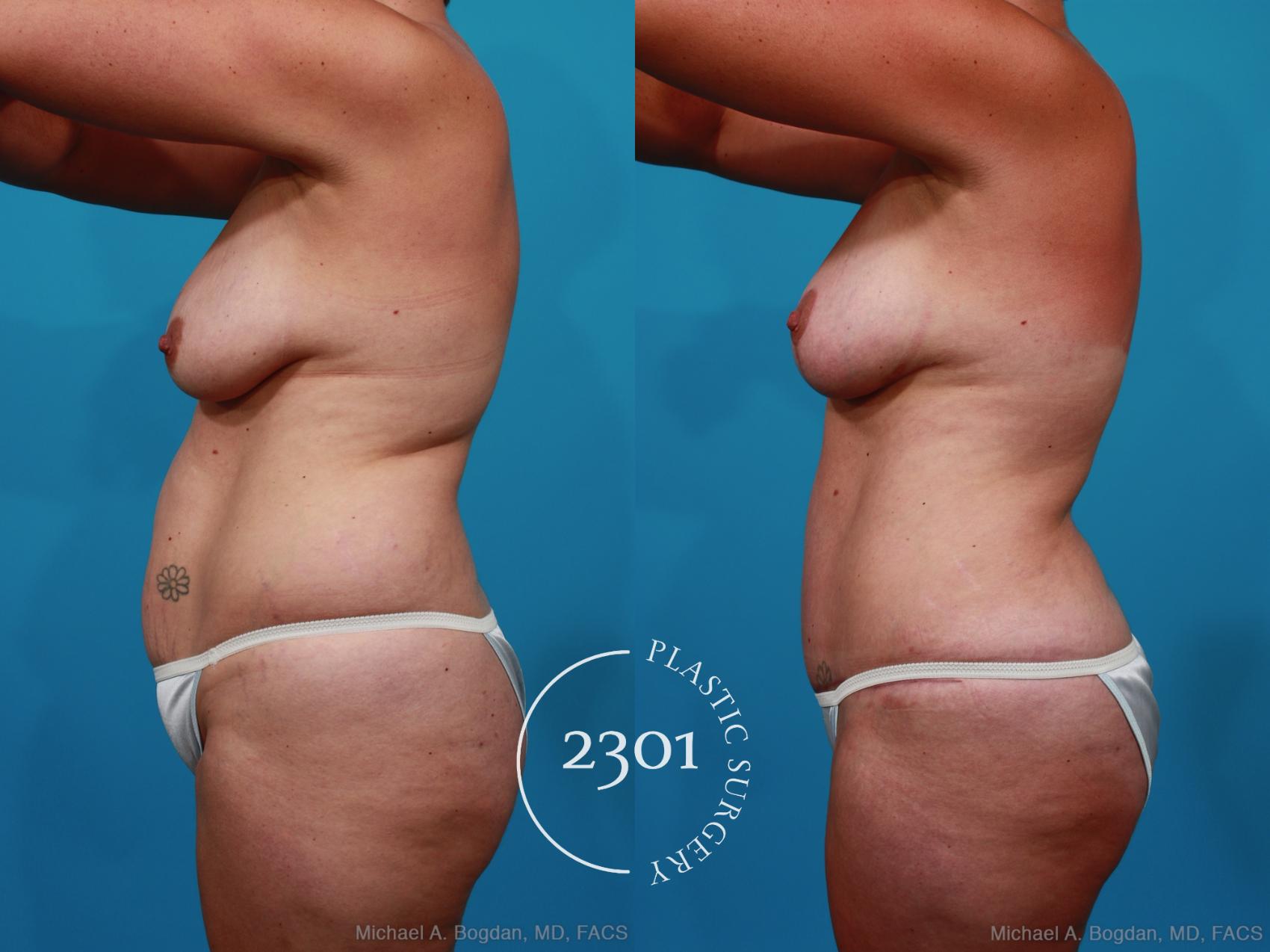Before & After Mommy Makeover Case 231 View #2 View in Fort Worth, Plano, & Frisco, Texas