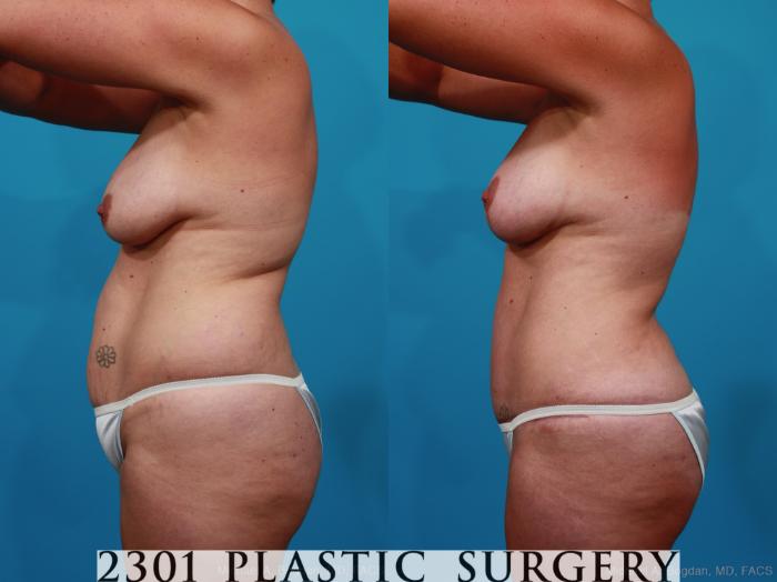 Before & After Tummy Tuck Case 231 View #2 View in Fort Worth, Plano, & Frisco, Texas