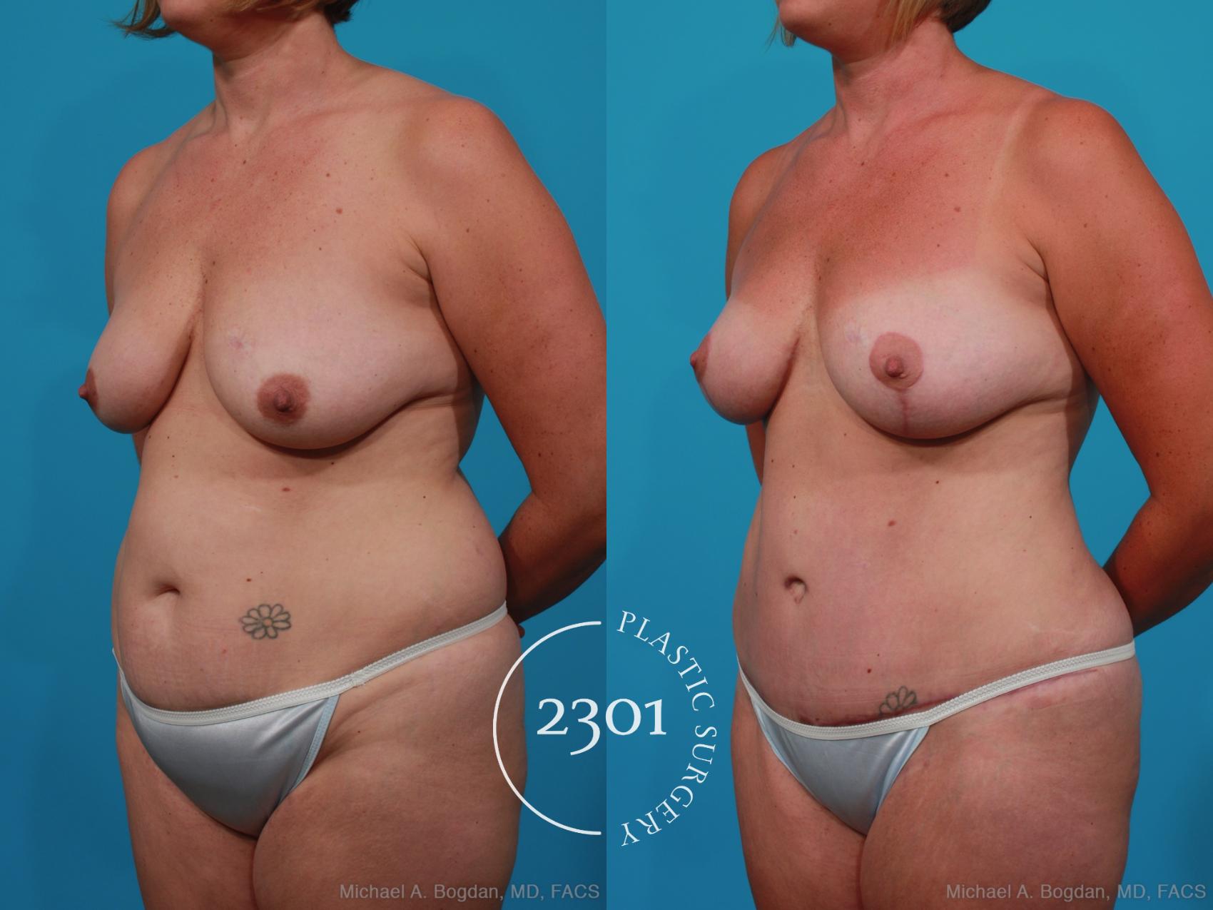 Before & After Mommy Makeover Case 231 View #3 View in Fort Worth, Plano, & Frisco, Texas