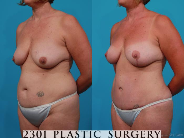 Before & After Mommy Makeover Case 231 View #3 View in Fort Worth, Plano, & Frisco, Texas