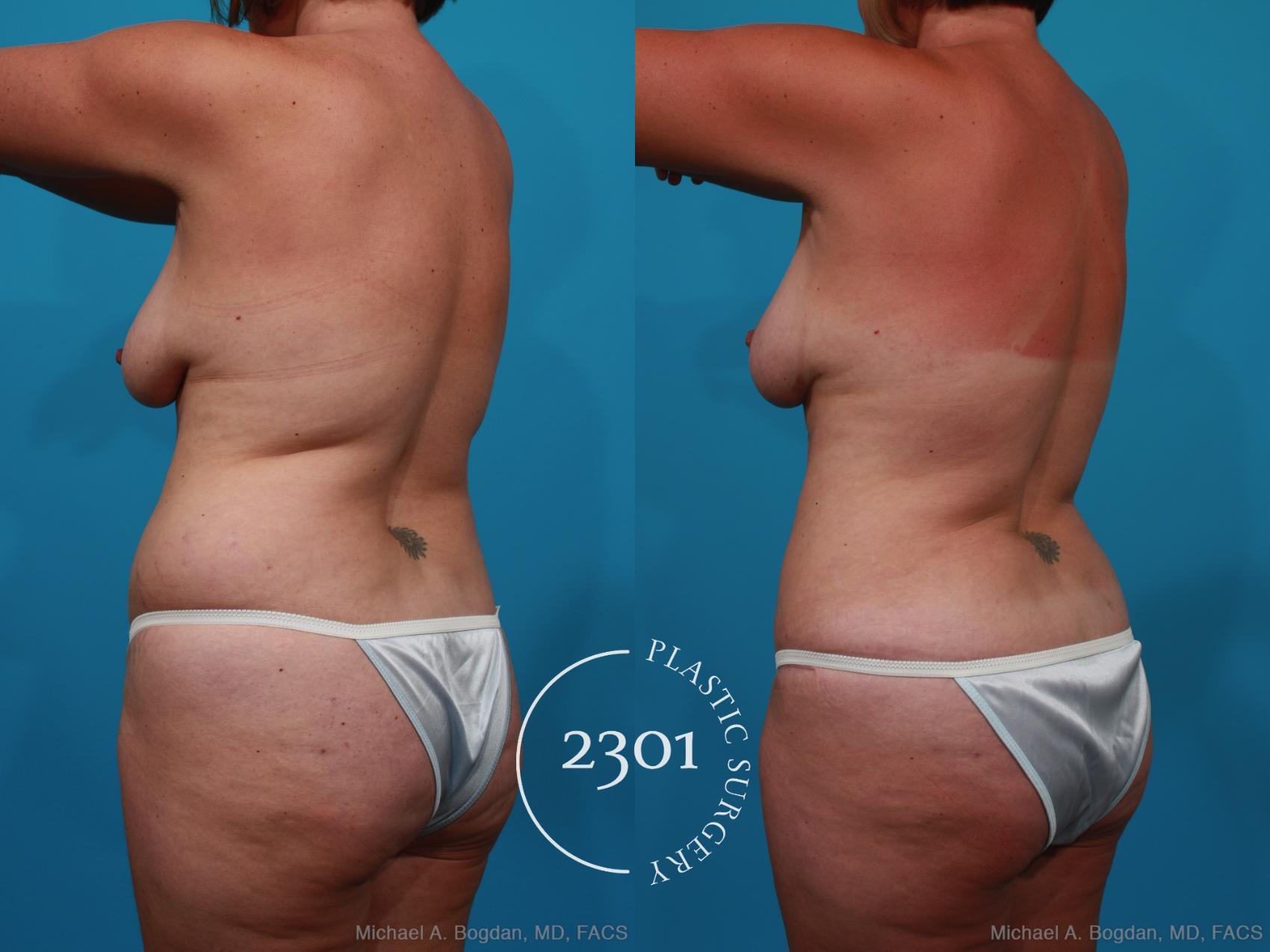 Before & After Mommy Makeover Case 231 View #4 View in Fort Worth, Plano, & Frisco, Texas