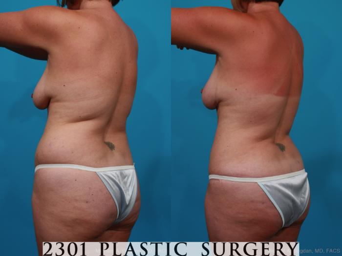 Before & After Mommy Makeover Case 231 View #4 View in Fort Worth, Plano, & Frisco, Texas