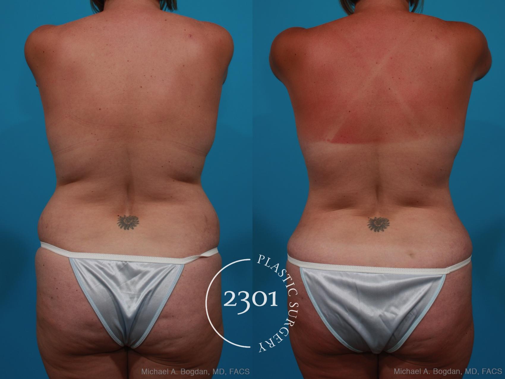 Before & After Mommy Makeover Case 231 View #5 View in Fort Worth, Plano, & Frisco, Texas