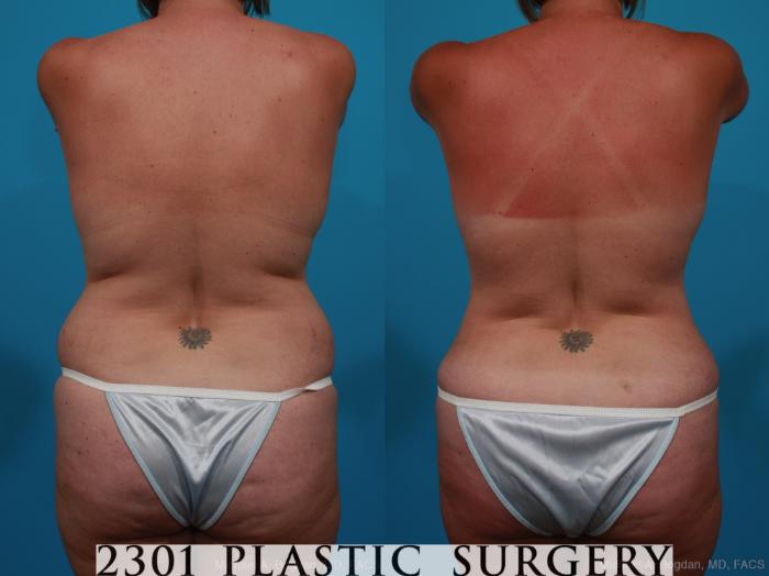 Before & After Tummy Tuck Case 231 View #5 View in Fort Worth, Plano, & Frisco, Texas