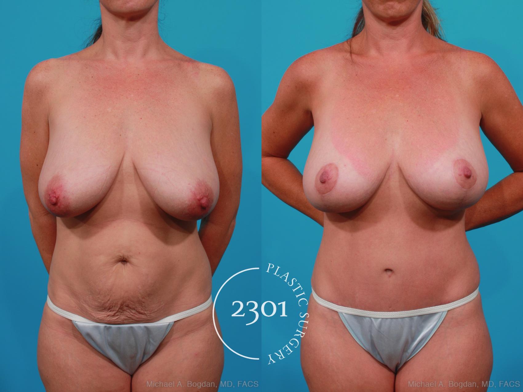 Before & After Tummy Tuck Case 232 View #1 View in Fort Worth, Plano, & Frisco, Texas