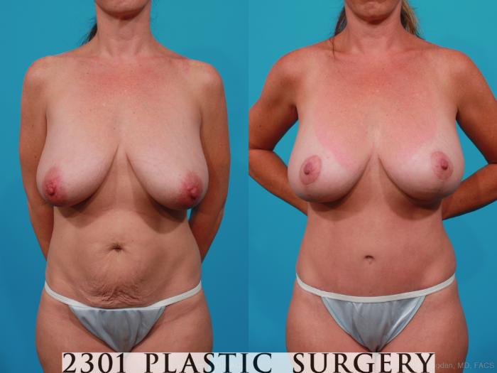 Before & After Tummy Tuck Case 232 View #1 View in Fort Worth, Plano, & Frisco, Texas