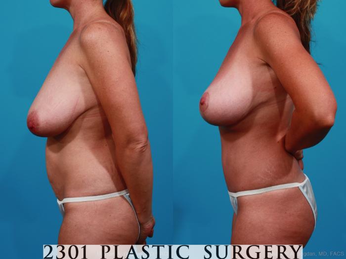 Before & After Breast Lift (Mastopexy) Case 232 View #2 View in Fort Worth, Plano, & Frisco, Texas