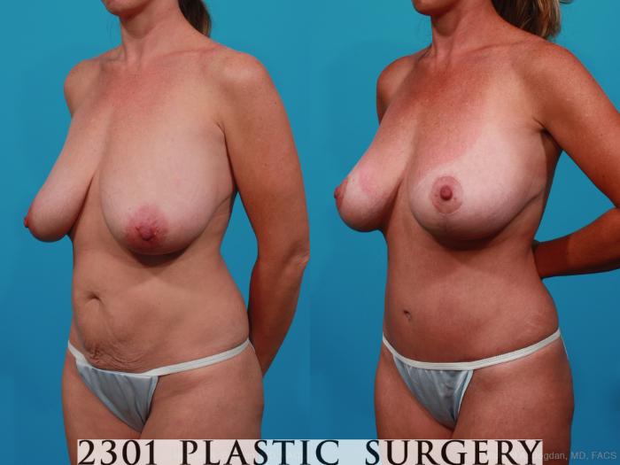 Before & After Tummy Tuck Case 232 View #3 View in Fort Worth, Plano, & Frisco, Texas