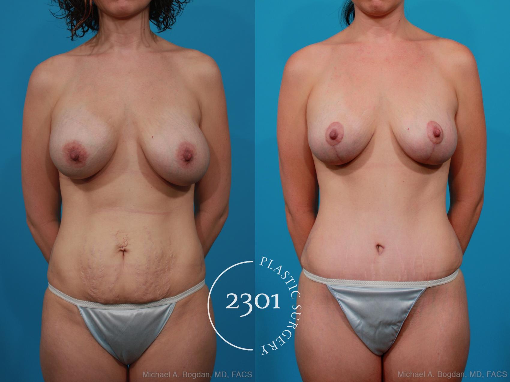 Before & After Breast Lift (Mastopexy) Case 233 View #1 View in Fort Worth, Plano, & Frisco, Texas