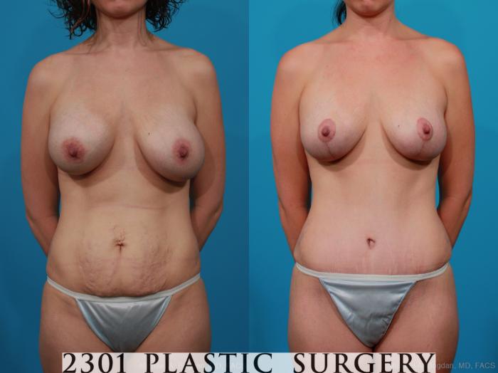 Before & After Breast Augmentation Revision Case 233 View #1 View in Fort Worth, Plano, & Frisco, Texas