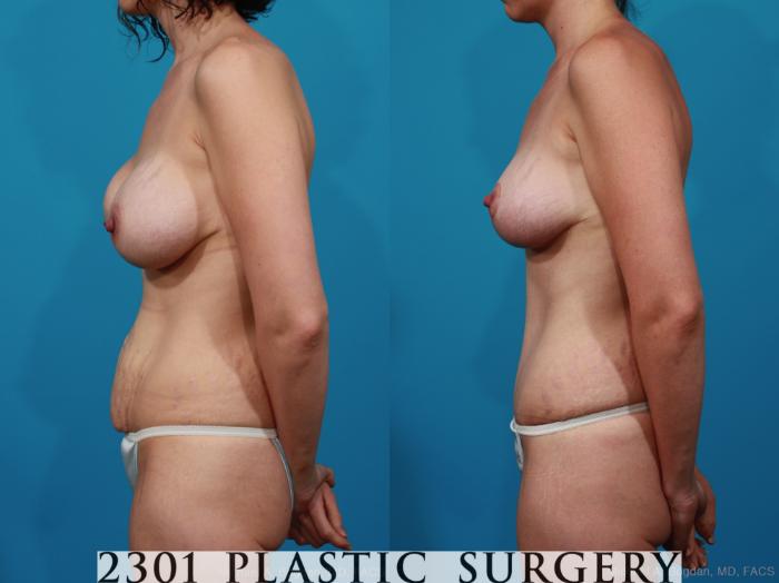 Before & After Breast Lift (Mastopexy) Case 233 View #2 View in Fort Worth, Plano, & Frisco, Texas
