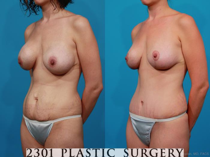 Before & After Saline Implants Case 233 View #3 View in Fort Worth, Plano, & Frisco, Texas