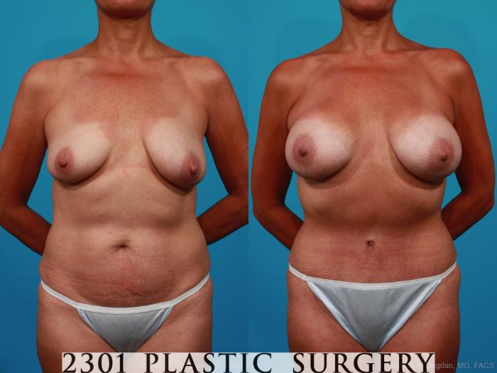 Before & After Tummy Tuck Case 236 View #1 View in Fort Worth, Plano, & Frisco, Texas