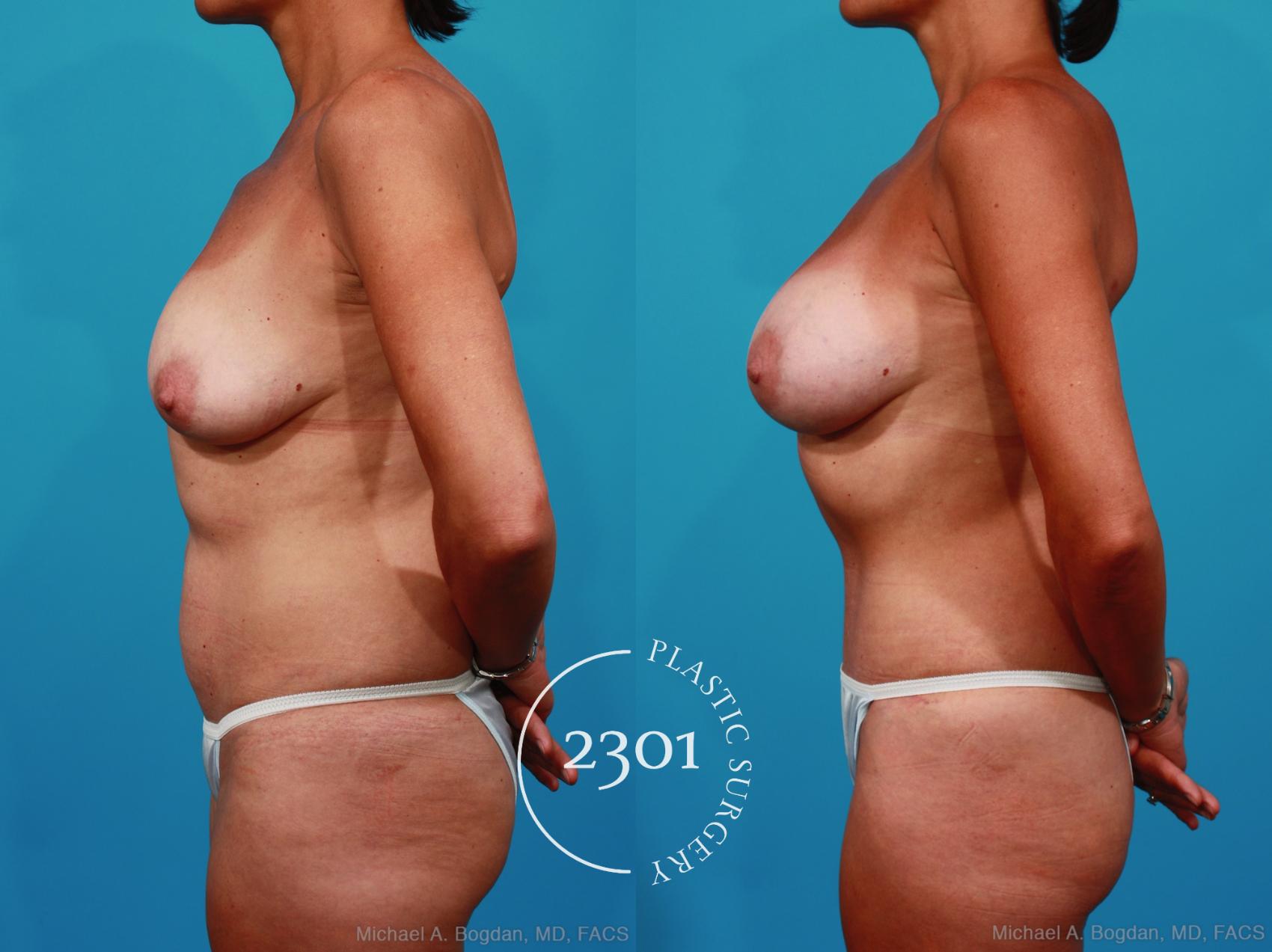 Before & After Silicone Implants Case 236 View #2 View in Fort Worth, Plano, & Frisco, Texas