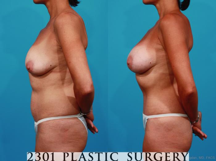 Before & After Silicone Implants Case 236 View #2 View in Fort Worth, Plano, & Frisco, Texas