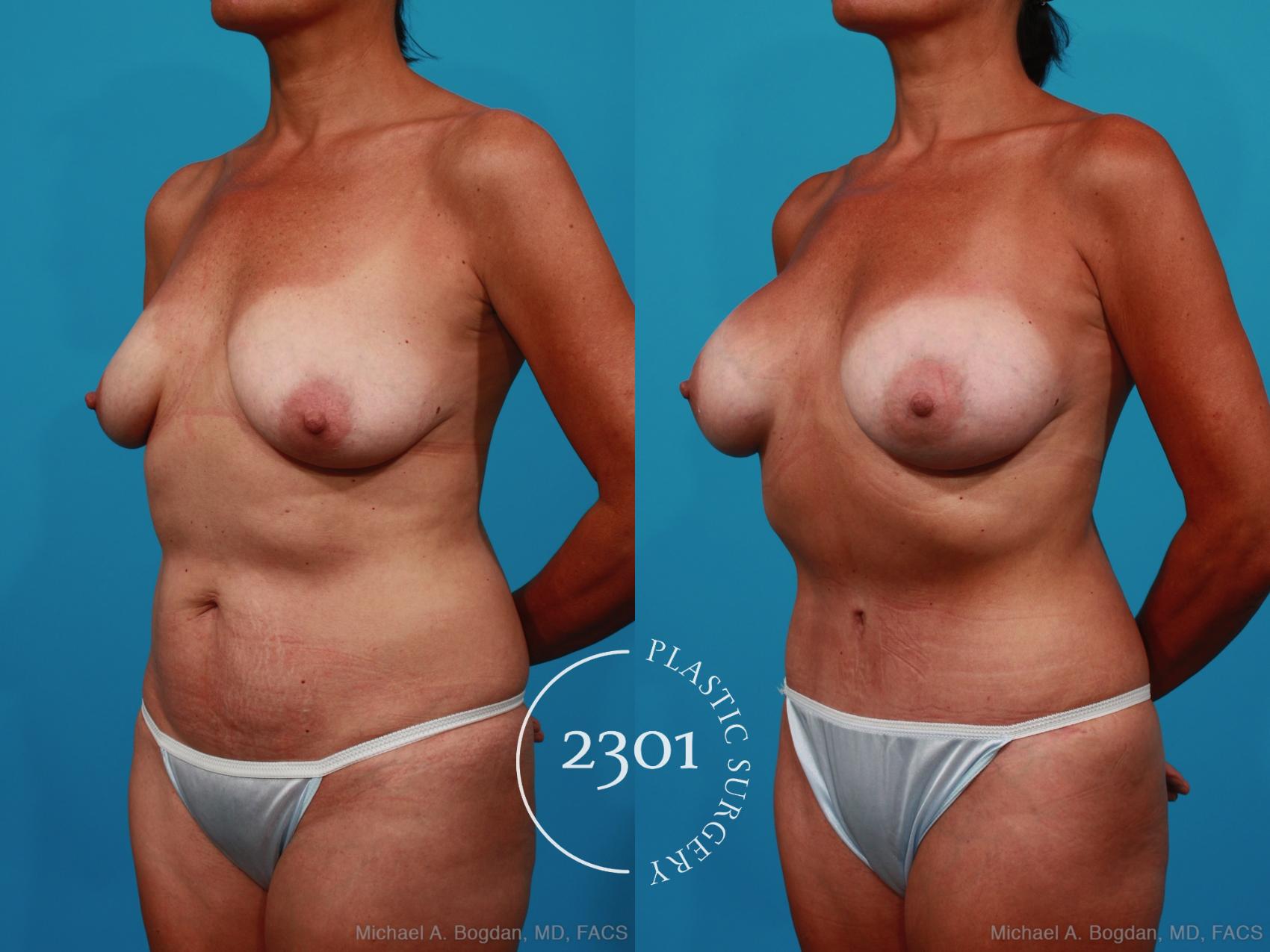 Before & After Silicone Implants Case 236 View #3 View in Fort Worth, Plano, & Frisco, Texas