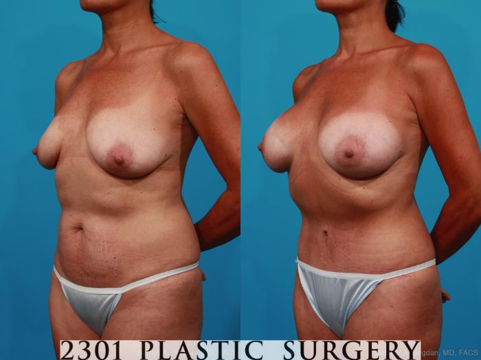 Before & After Silicone Implants Case 236 View #3 View in Fort Worth, Plano, & Frisco, Texas