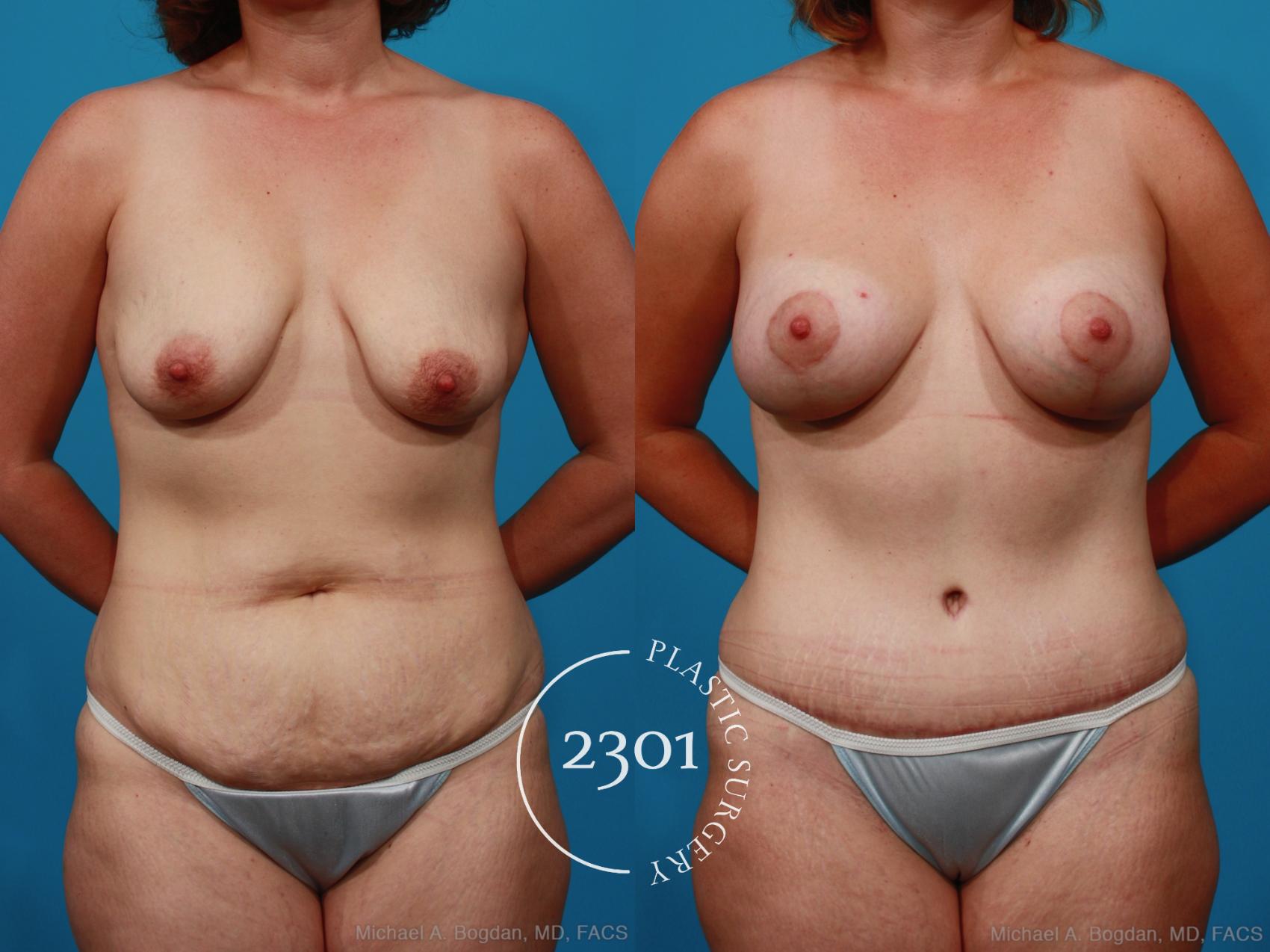 Before & After Tummy Tuck Case 237 View #1 View in Fort Worth, Plano, & Frisco, Texas