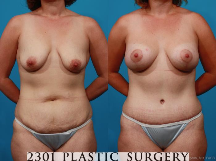 Before & After Breast Lift (Mastopexy) Case 237 View #1 View in Fort Worth, Plano, & Frisco, Texas