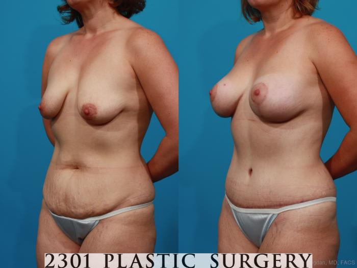 Before & After Silicone Implants Case 237 View #3 View in Fort Worth, Plano, & Frisco, Texas