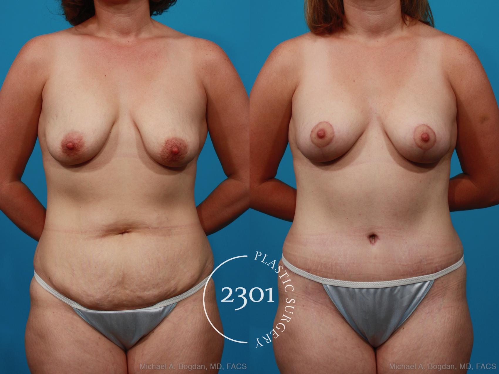 Before & After Silicone Implants Case 237 View #4 View in Fort Worth, Plano, & Frisco, Texas